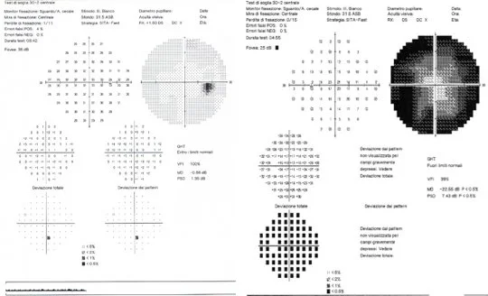 Esame del campo visivo computerizzato