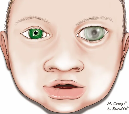 Diagnosi di glaucoma: Esempio di buftalmo