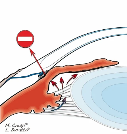 Diagnosi: Glaucoma primario ad angolo chiuso