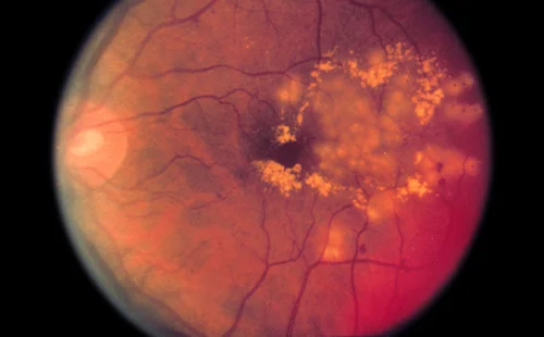 Maculopatia e retinopatia diabetiche: quale impatto?