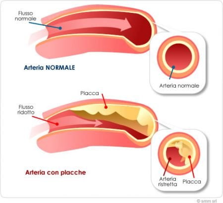 Diabete Tipo 2: 1 Persona Su 3 Ha Una Malattia Cardiovascolare ...